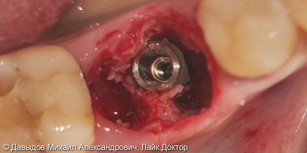 Удаление зуба 36 с одномоментной установкой импланта - фото №3