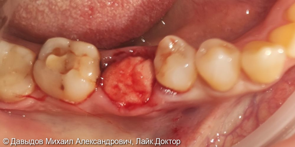 Удаление зуба 36 с одномоментной установкой импланта - фото №5
