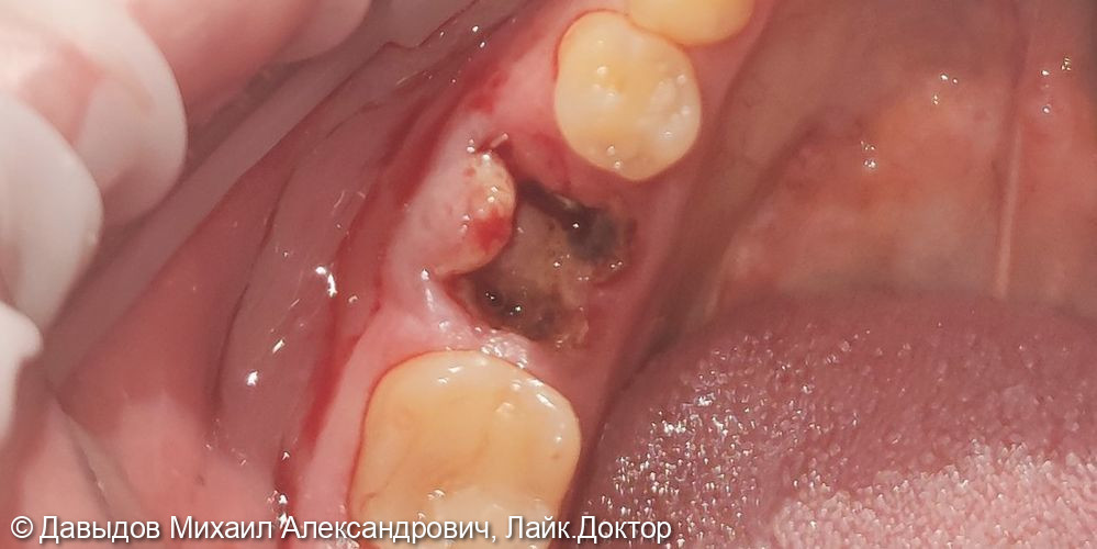 Удаление зуба с одномоментной имплантацией - фото №1
