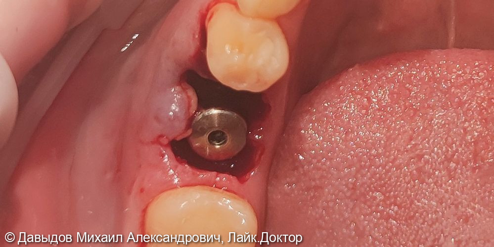 Удаление зуба с одномоментной имплантацией - фото №3