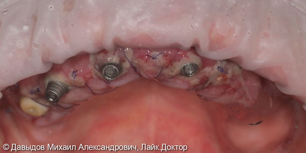 Имплантация на верхней челюсти с немедленной нагрузкой - фото №5