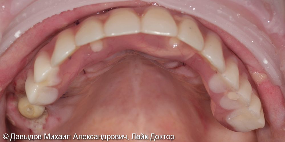 Имплантация на верхней челюсти с немедленной нагрузкой - фото №9