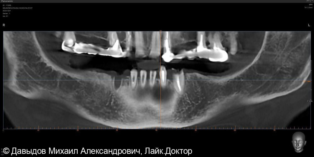 Установка 4х имплантов на нижней челюсти с немедленной нагрузкой временным фрезерованным протезом из ПММА - фото №2