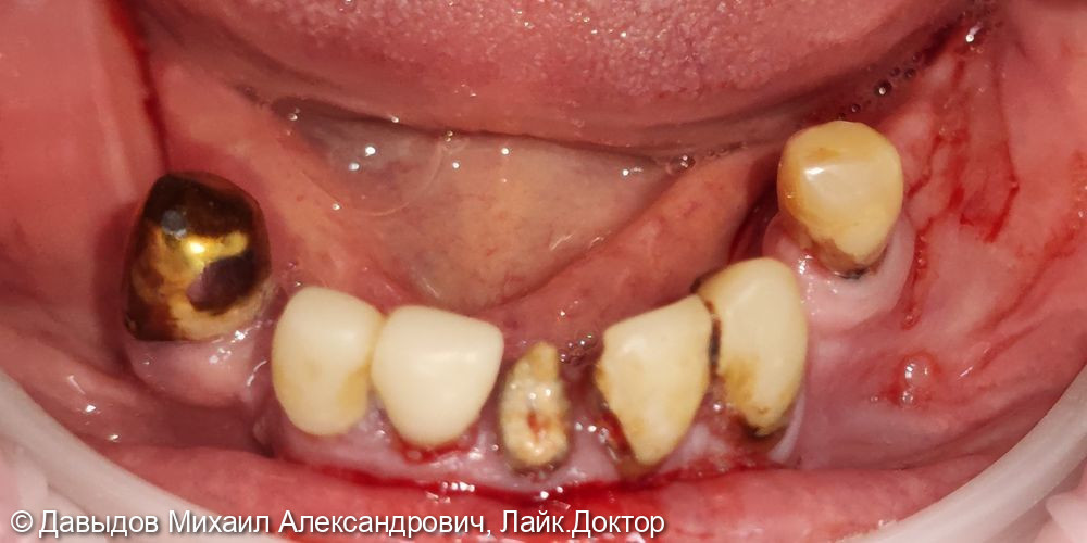 Имплантация с одномоментной нагрузкой на нижней челюсти - фото №2
