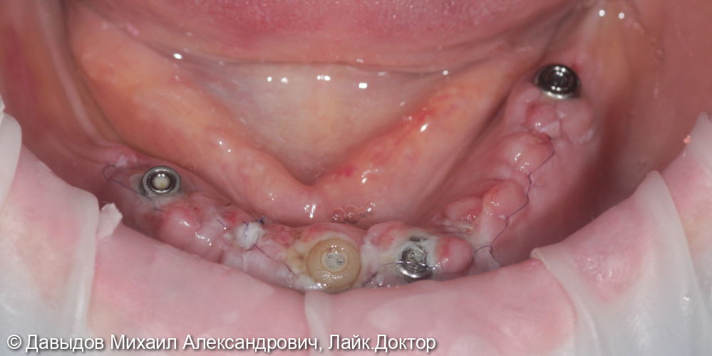 Имплантация с одномоментной нагрузкой на нижней челюсти - фото №5