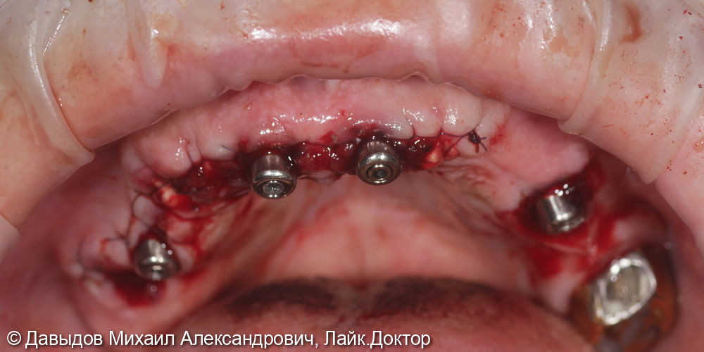 Тотальное протезирование верхней челюсти на имплантах - фото №3