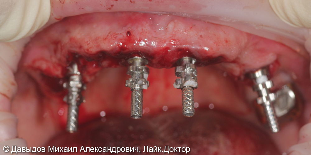 Тотальное протезирование верхней челюсти на имплантах - фото №4