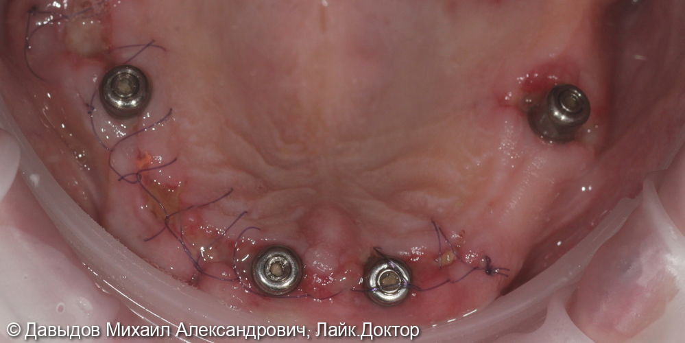 Тотальное протезирование верхней челюсти на имплантах - фото №6