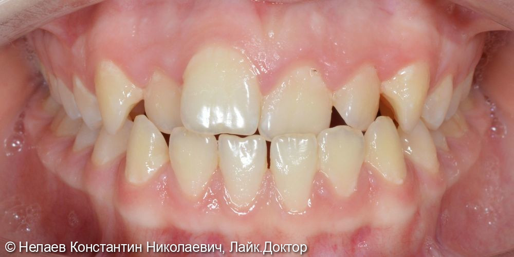 Скученность фронтальных зубов верхней челюсти и нижней челюсти - фото №1
