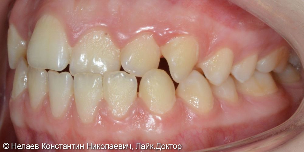 Скученность фронтальных зубов верхней челюсти и нижней челюсти - фото №2