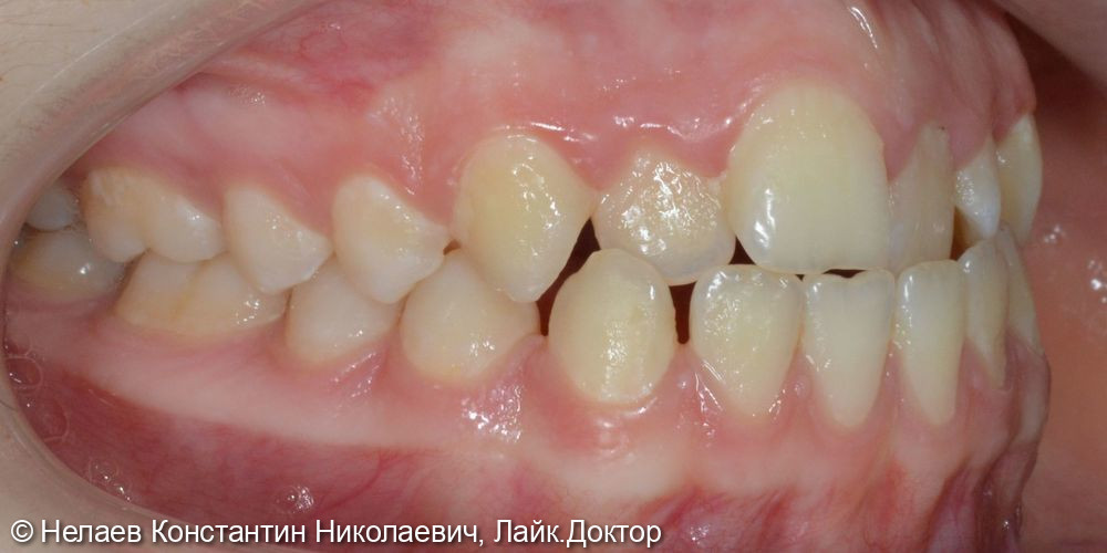 Скученность фронтальных зубов верхней челюсти и нижней челюсти - фото №3