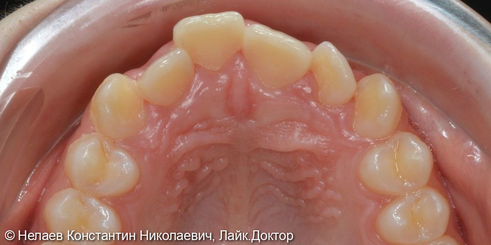 Скученность фронтальных зубов верхней челюсти и нижней челюсти - фото №4