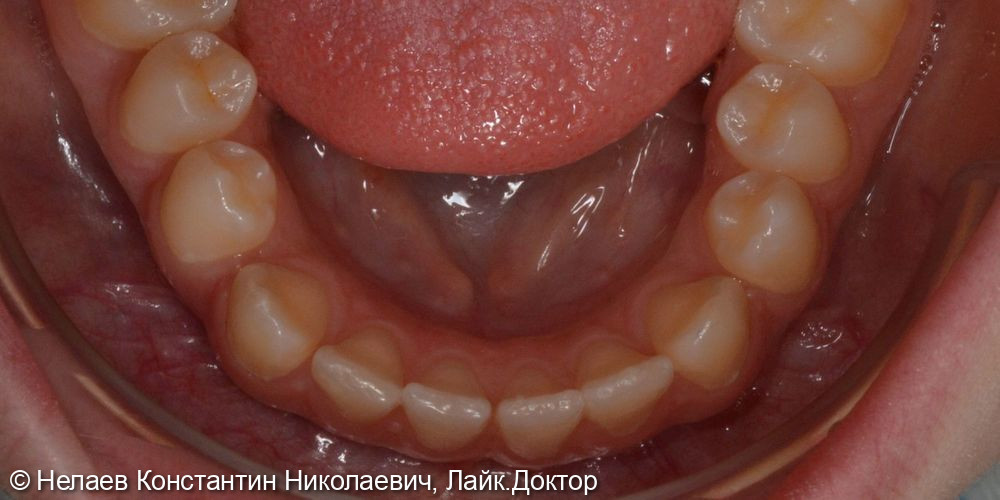 Скученность фронтальных зубов верхней челюсти и нижней челюсти - фото №5
