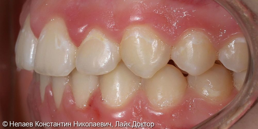 Скученность фронтальных зубов верхней челюсти и нижней челюсти - фото №6