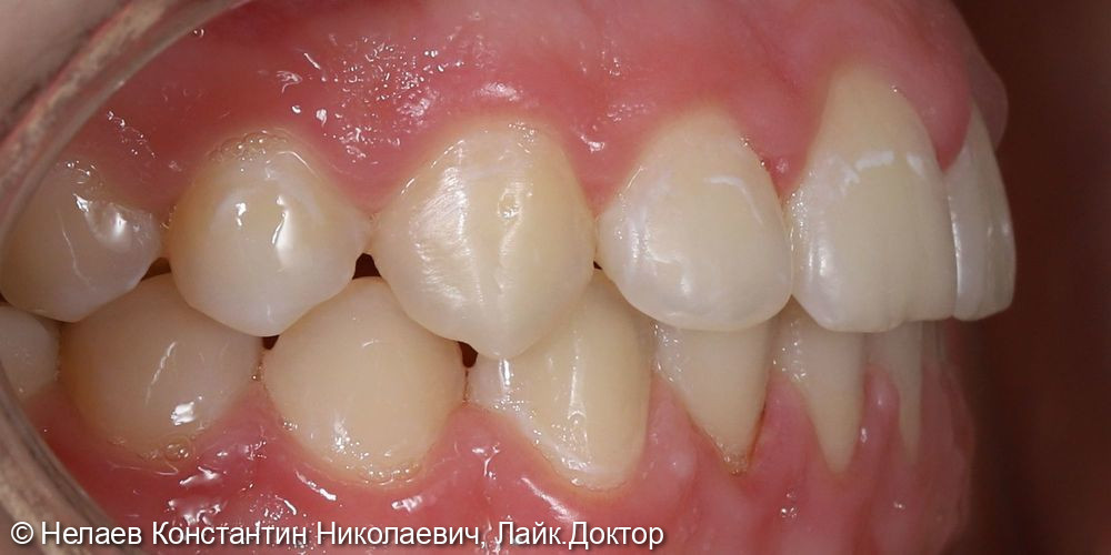 Скученность фронтальных зубов верхней челюсти и нижней челюсти - фото №7