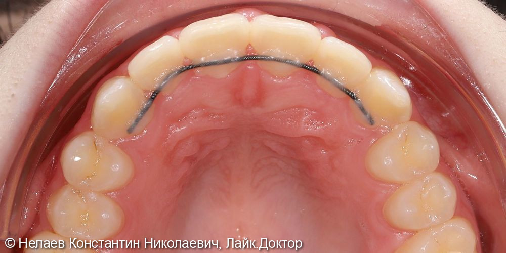 Скученность фронтальных зубов верхней челюсти и нижней челюсти - фото №8