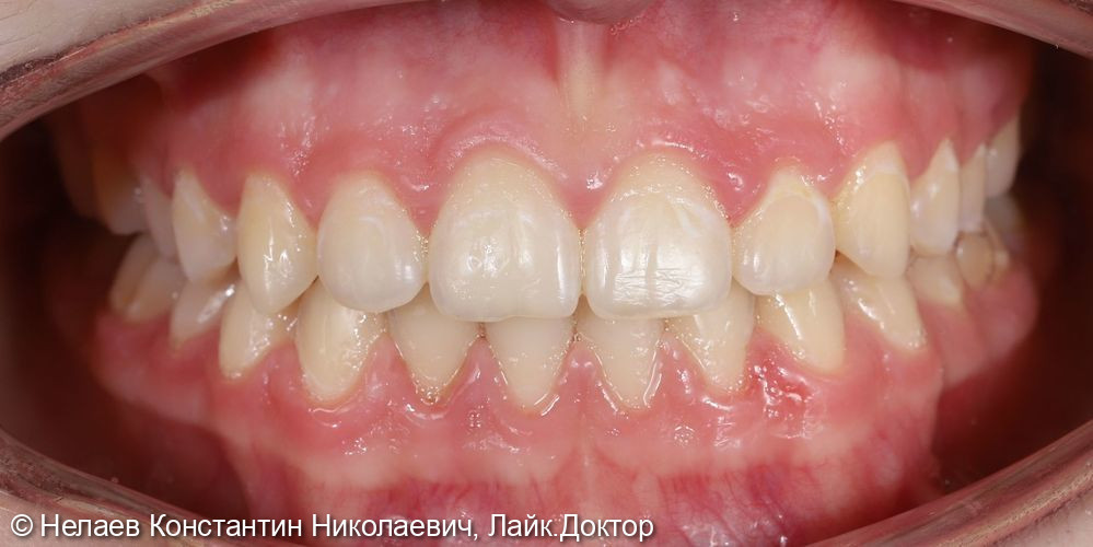 Скученность фронтальных зубов верхней челюсти и нижней челюсти - фото №10