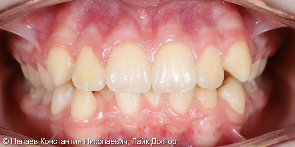 Ортодонтическое лечение на брекетах Damon Q - фото №1