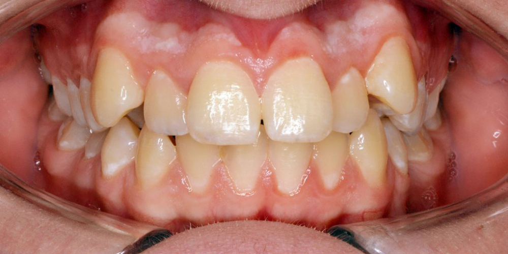 Нейтральное соотношение зубных рядов и апикальных базисов - фото №1