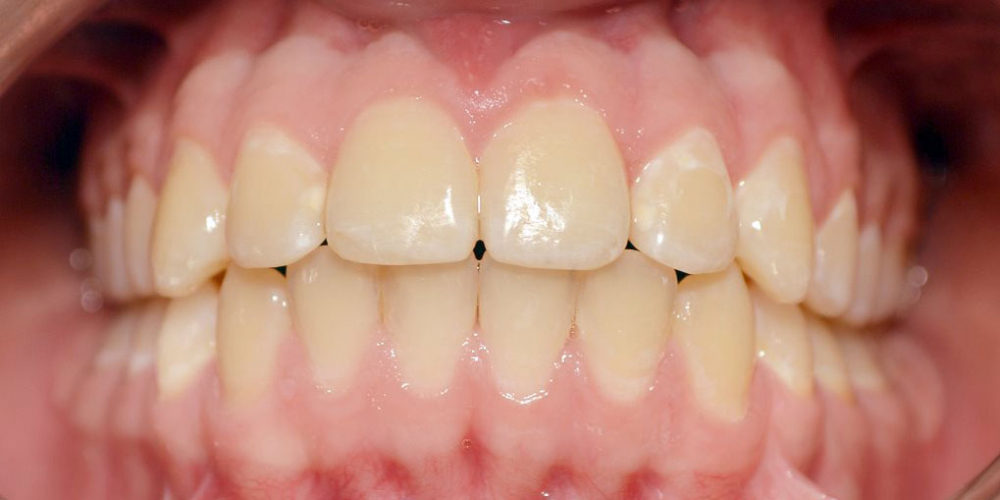 Нейтральное соотношение зубных рядов и апикальных базисов - фото №10