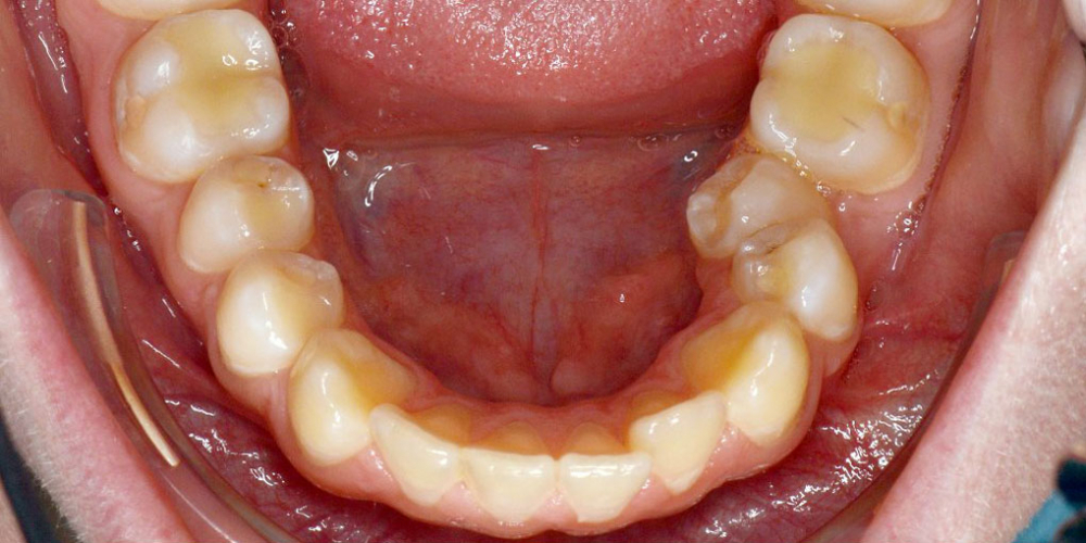 Нейтральное соотношение зубных рядов и апикальных базисов - фото №3