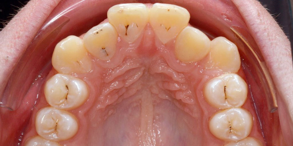 Нейтральное соотношение зубных рядов и апикальных базисов - фото №4