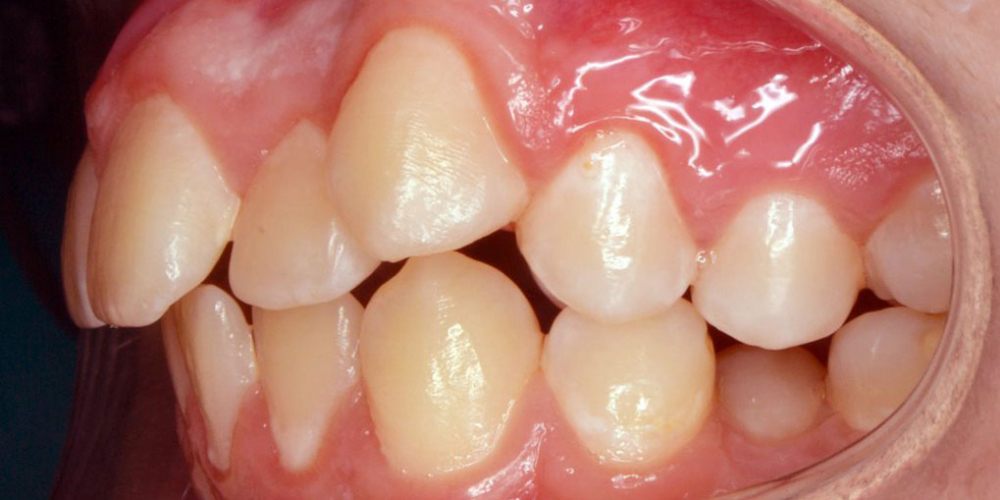 Нейтральное соотношение зубных рядов и апикальных базисов - фото №5