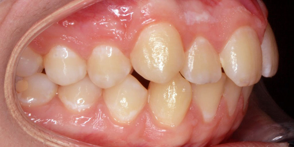 Нейтральное соотношение зубных рядов и апикальных базисов - фото №6