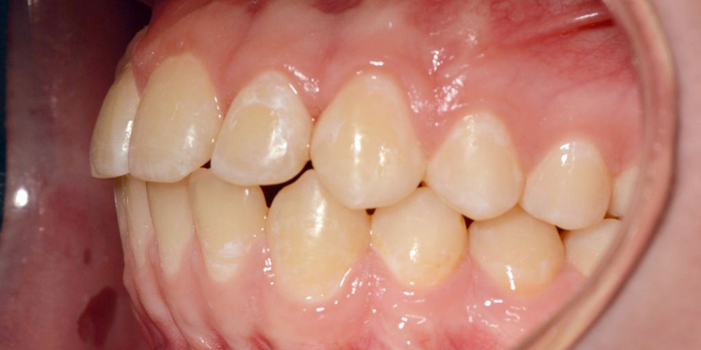 Нейтральное соотношение зубных рядов и апикальных базисов - фото №8