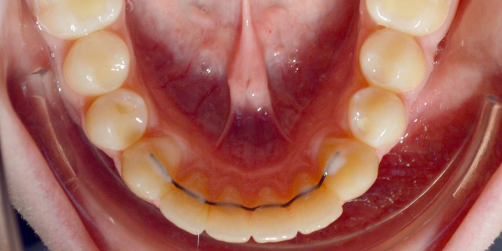 Нейтральное соотношение зубных рядов и апикальных базисов - фото №2