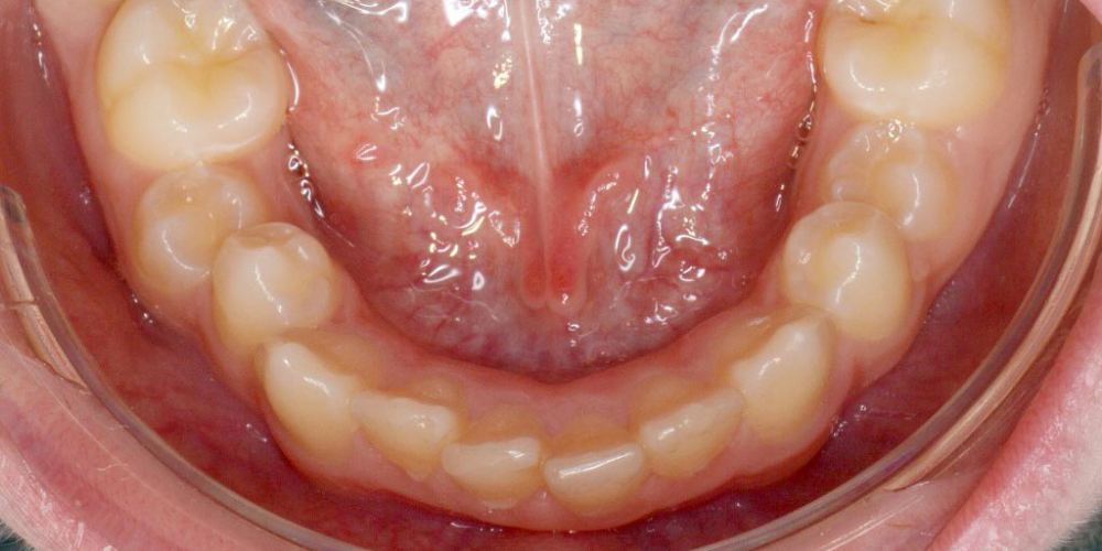Дистальный прикус, умеренная скученность резцов верхней и нижней челюсти - фото №3