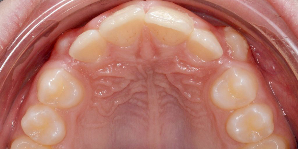 Дистальный прикус, умеренная скученность резцов верхней и нижней челюсти - фото №4