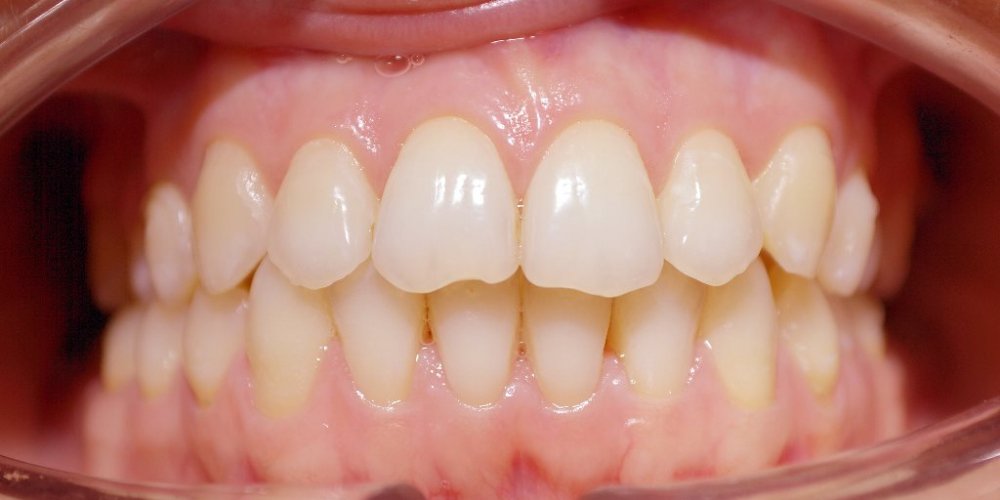 Исправление скученности зубов на верхней и нижней чеюсти - фото №4