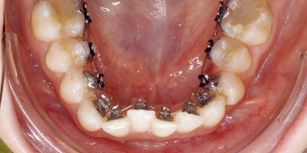 Исправление скученности зубов на верхней и нижней чеюсти - фото №3