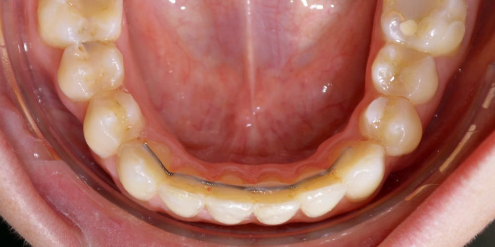 Исправление скученности зубов на верхней и нижней чеюсти - фото №2