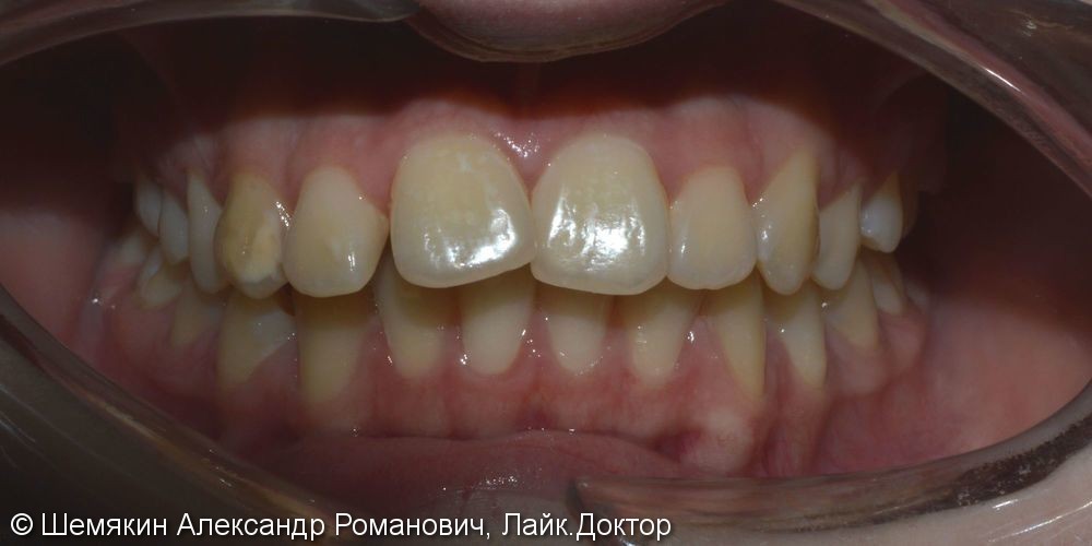 Протрузия фронтальных зубов на верхней челюсти, нарушение ангуляции - фото №1