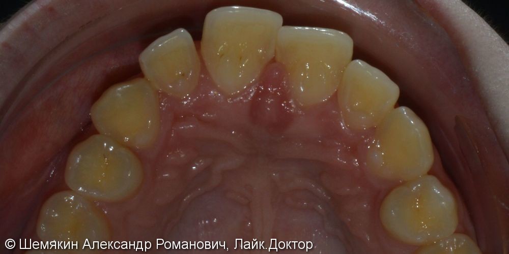 Протрузия фронтальных зубов на верхней челюсти, нарушение ангуляции - фото №2
