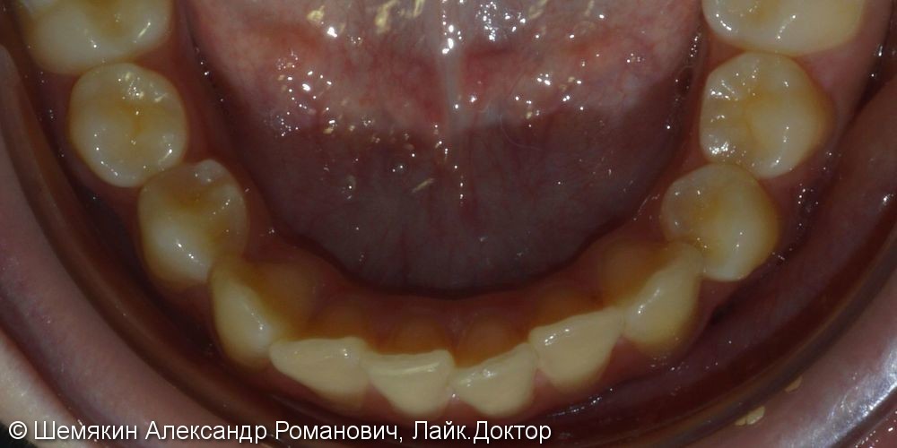Протрузия фронтальных зубов на верхней челюсти, нарушение ангуляции - фото №3
