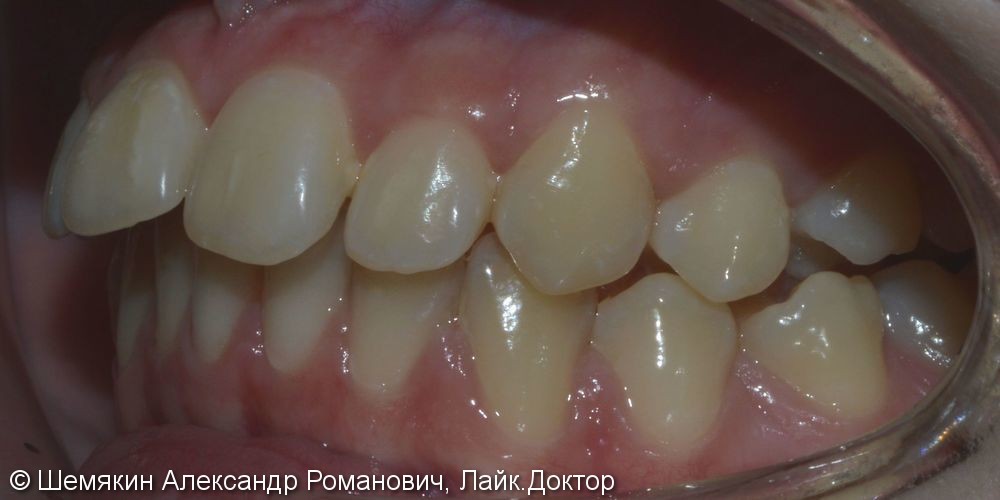Протрузия фронтальных зубов на верхней челюсти, нарушение ангуляции - фото №4