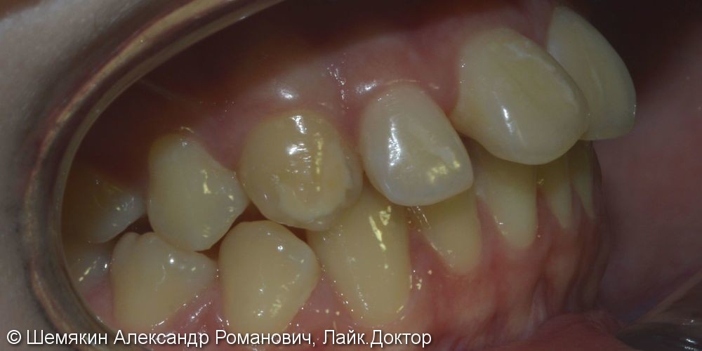 Протрузия фронтальных зубов на верхней челюсти, нарушение ангуляции - фото №5