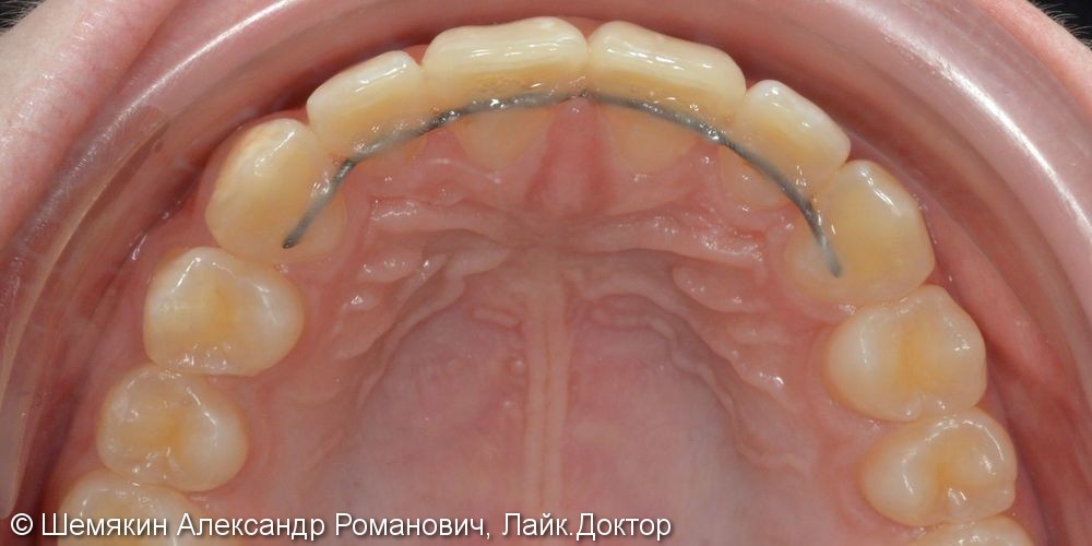 Протрузия фронтальных зубов на верхней челюсти, нарушение ангуляции - фото №6