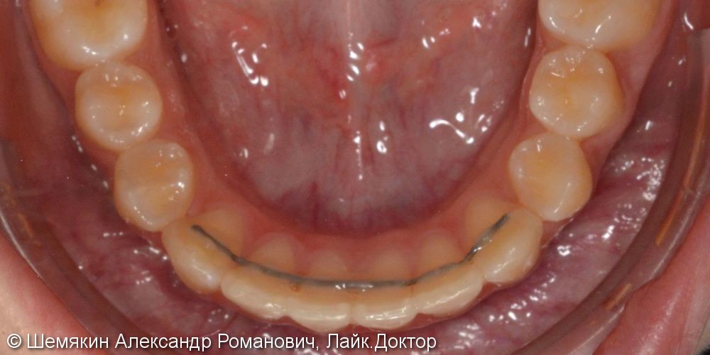 Протрузия фронтальных зубов на верхней челюсти, нарушение ангуляции - фото №7