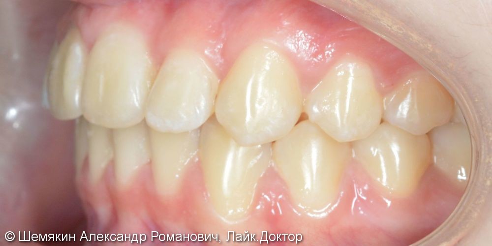 Протрузия фронтальных зубов на верхней челюсти, нарушение ангуляции - фото №8
