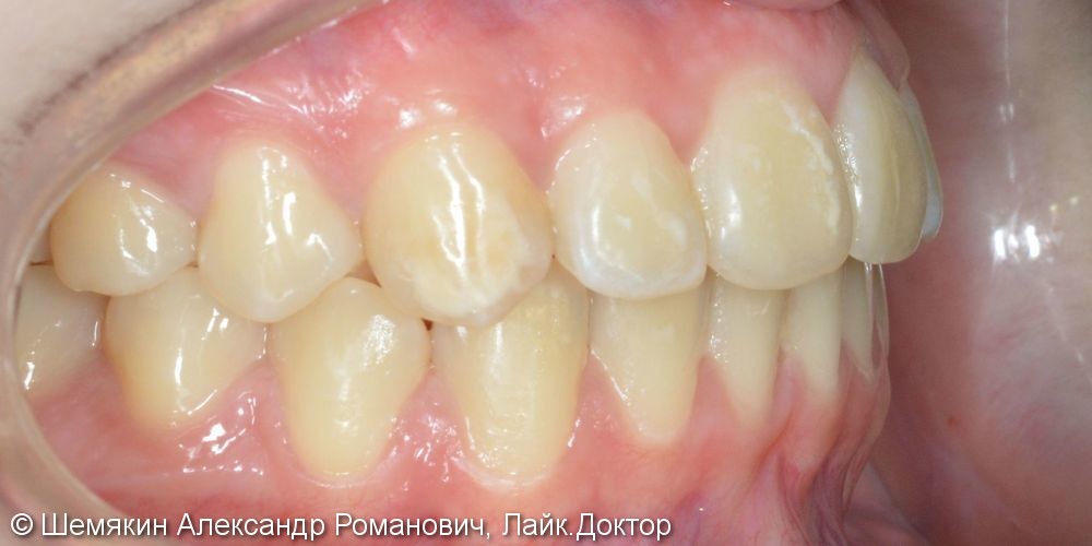Протрузия фронтальных зубов на верхней челюсти, нарушение ангуляции - фото №9
