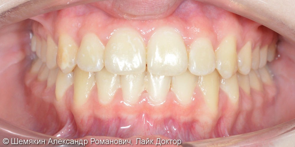 Протрузия фронтальных зубов на верхней челюсти, нарушение ангуляции - фото №10