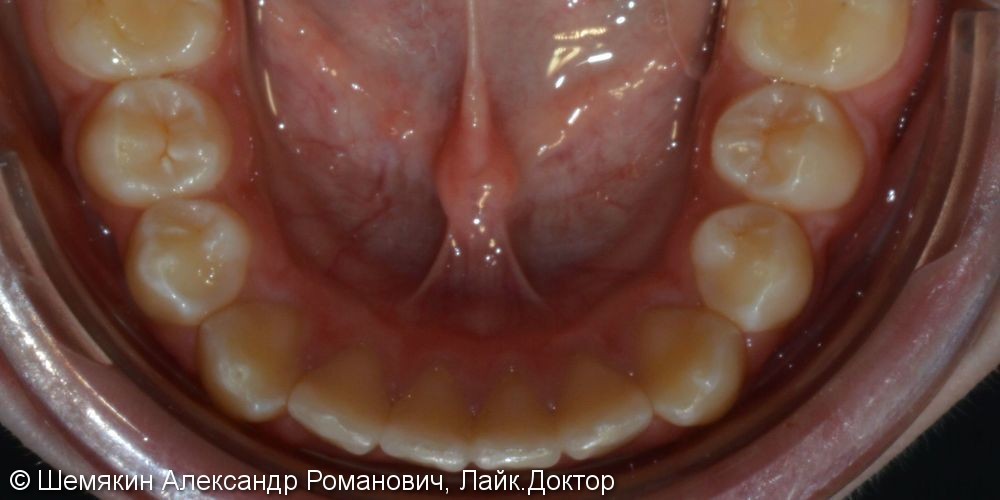 Смыкание первых моляров по 2 классу Энгля, результат до и после - фото №3