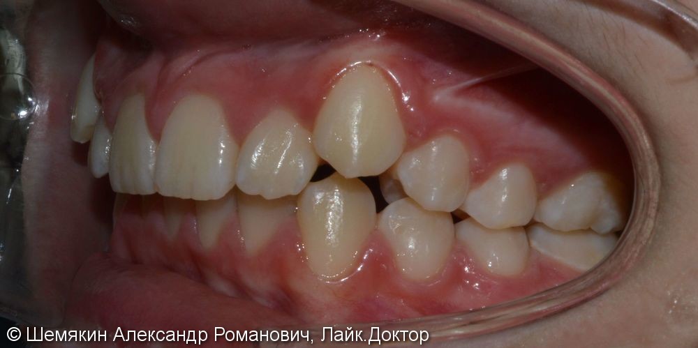 Смыкание первых моляров по 2 классу Энгля, результат до и после - фото №4