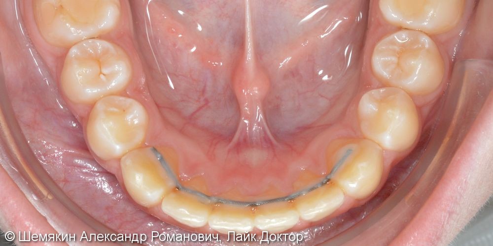Смыкание первых моляров по 2 классу Энгля, результат до и после - фото №7