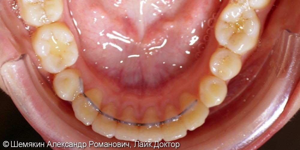 Дистальный прикус, 27 месяцев до и после лечения - фото №8