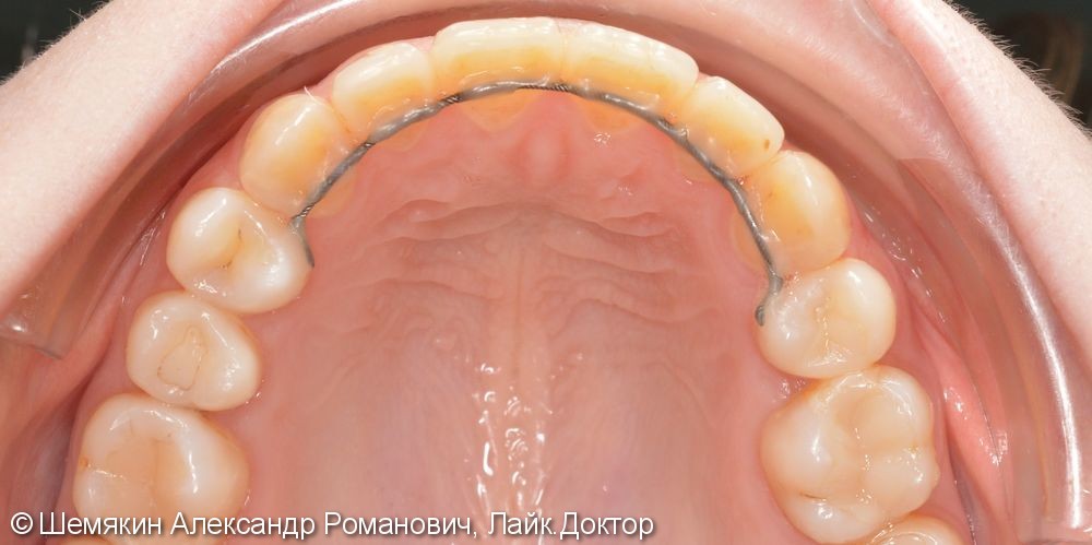 Исправление дистального прикуса лингвальными брекетами, до и после - фото №8